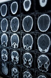 Catastrophic Injury Lawyer in St. Paul, Minnesota